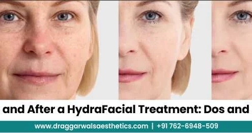 HydraFacial Treatment: Dos and Don’ts