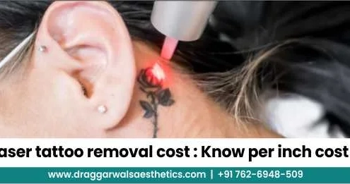Laser Tattoo Removal Cost in 2025 | Per Inch Pricing Guide