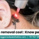Laser Tattoo Removal Cost in 2025 | Per Inch Pricing Guide