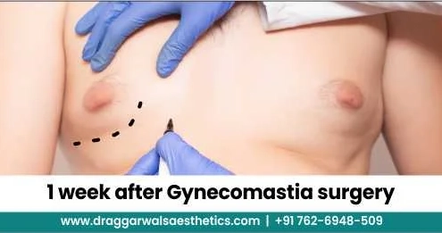 1 Week After Gynecomastia