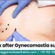 1 Week After Gynecomastia