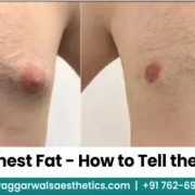 Gynecomastia vs Chest Fat