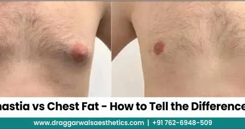Gynecomastia vs Chest Fat