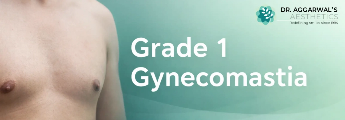 Grade 1 Gynecomastia