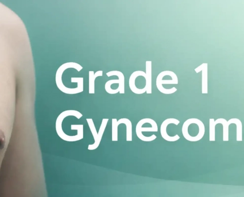 Grade 1 Gynecomastia