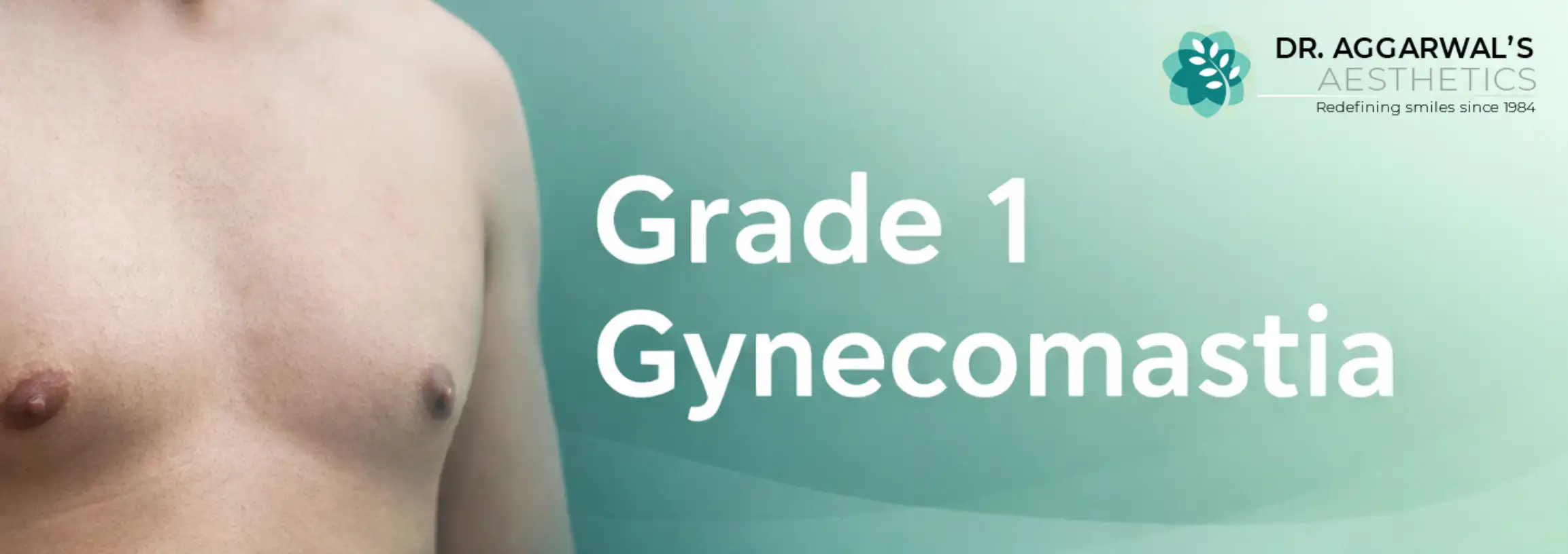 Grade 1 Gynecomastia